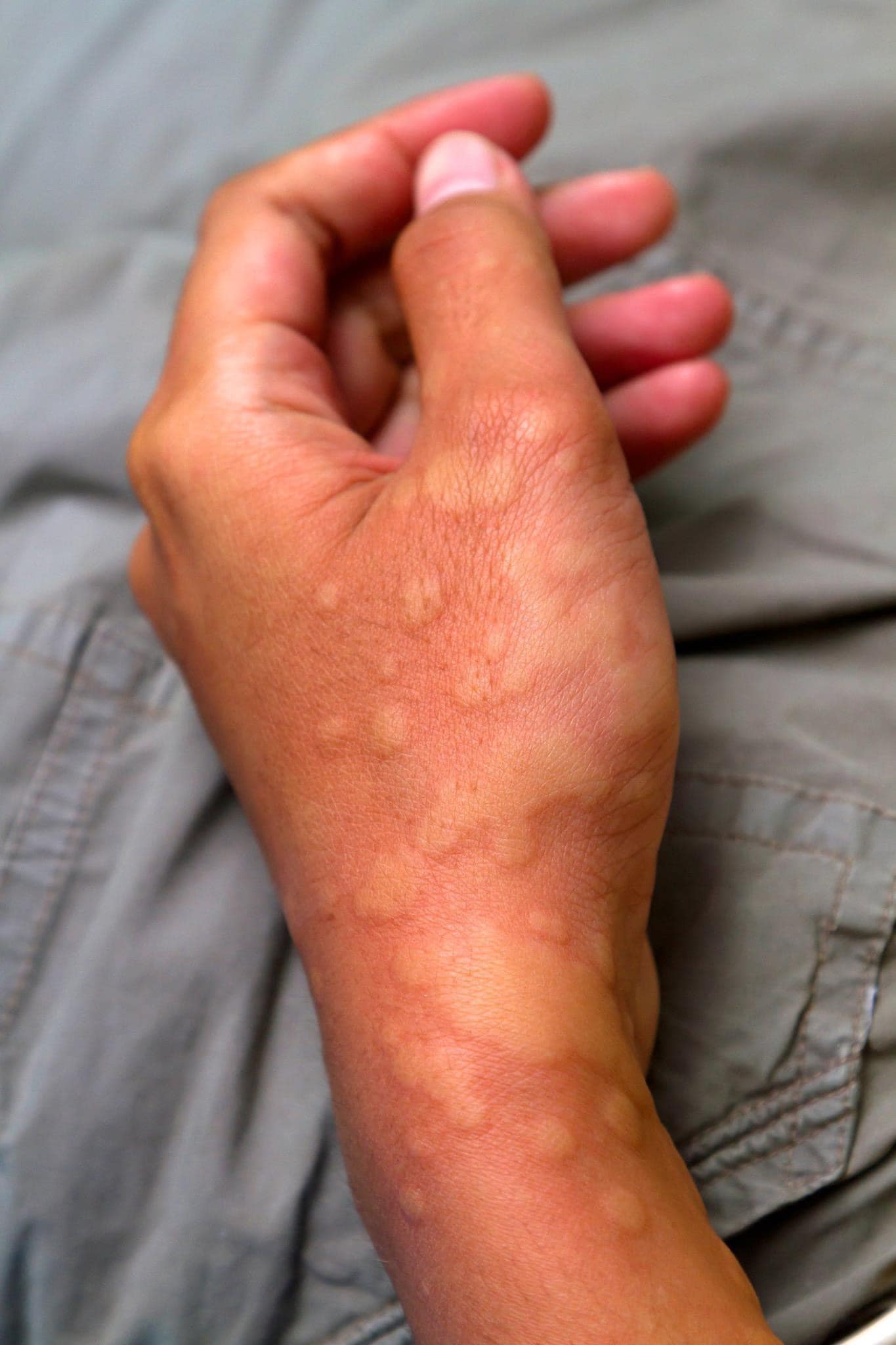 SKIN ALLERGY/UTICARIA /कर्कश, पित्ती