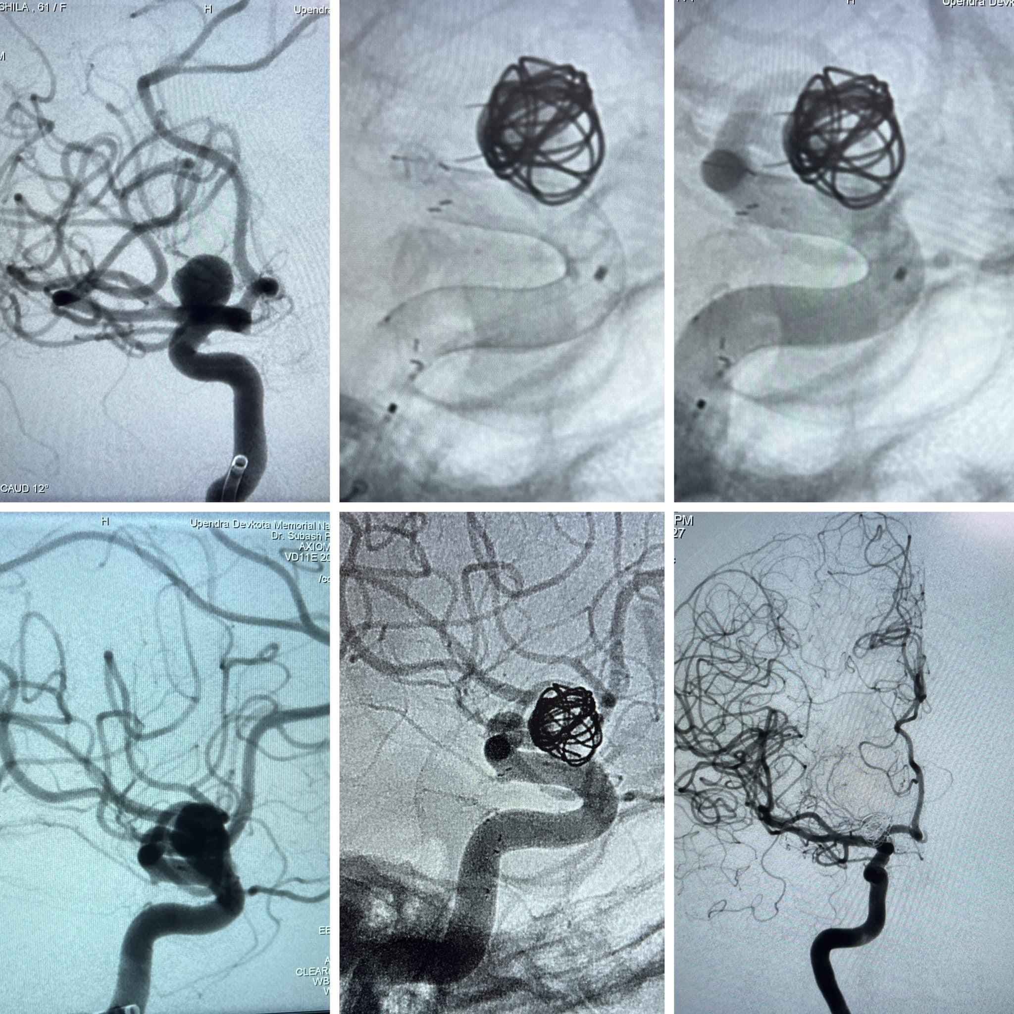 Endovascular Coiling -Neurointervention Nepal Awareness- Dr Subash Phuyal