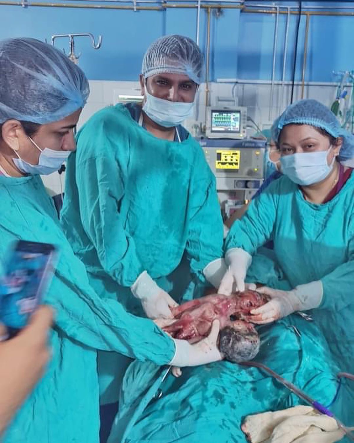 Conjoined IUD Twins (Thoracoomphalopagus) delivered by OBGYN team of NMCTH .